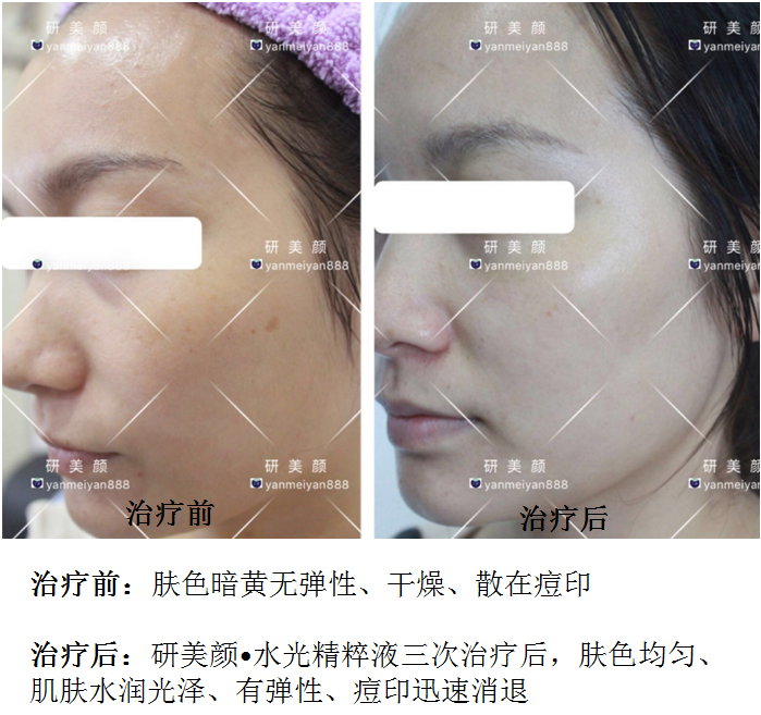 研美颜水光精粹液治疗前后对比图.png
