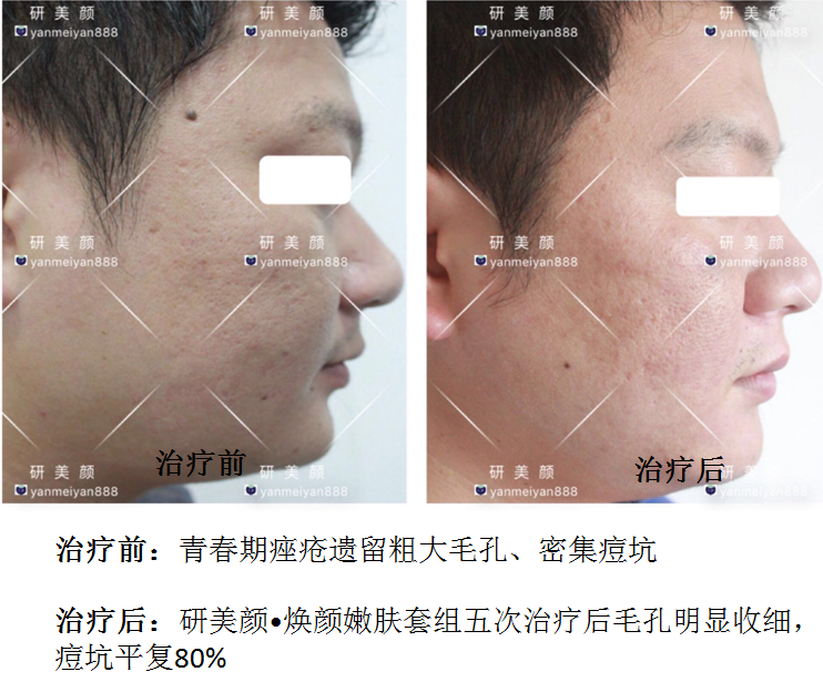 研美颜焕颜嫩肤套组套组治疗前后对比.png