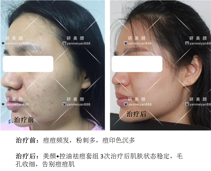 研美颜祛痘控油套组治疗前后对比图.png