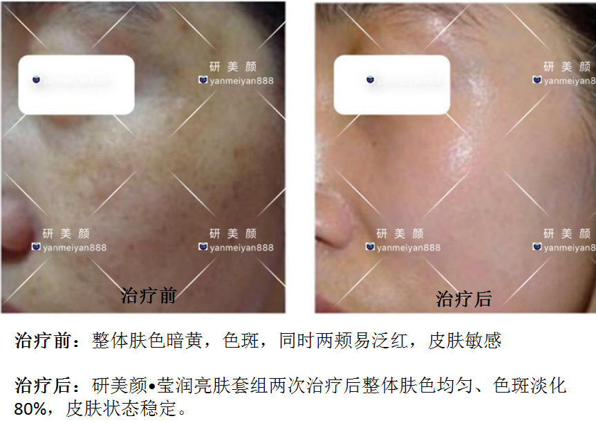 研美颜莹润亮肤套组治疗前后对比.png